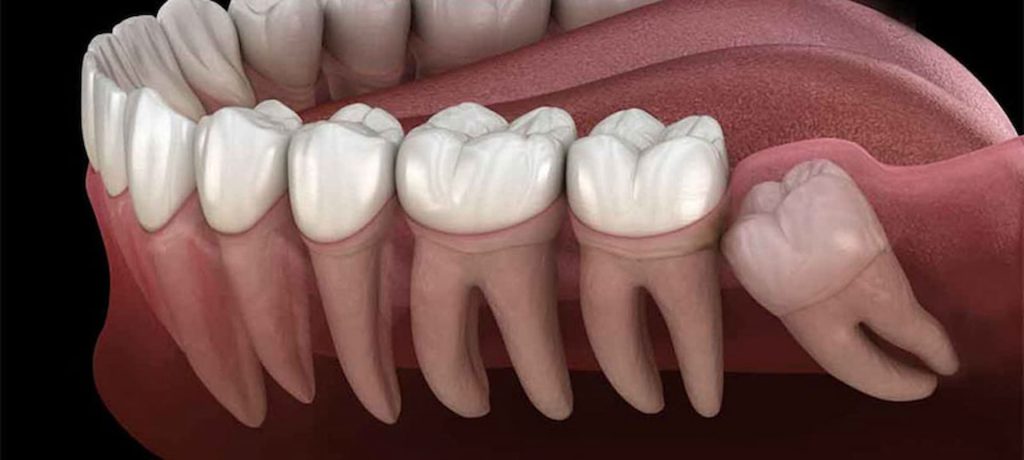 چالش‌ها و تکنیک‌های جراحی برای دندان‌های نهفته