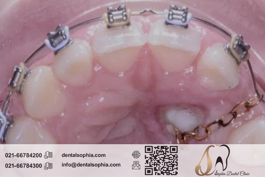 چالش‌ها و تکنیک‌های جراحی برای دندان‌های نهفته