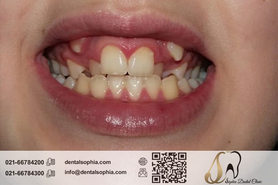 چالش‌ها و تکنیک‌های جراحی برای دندان‌های نهفته