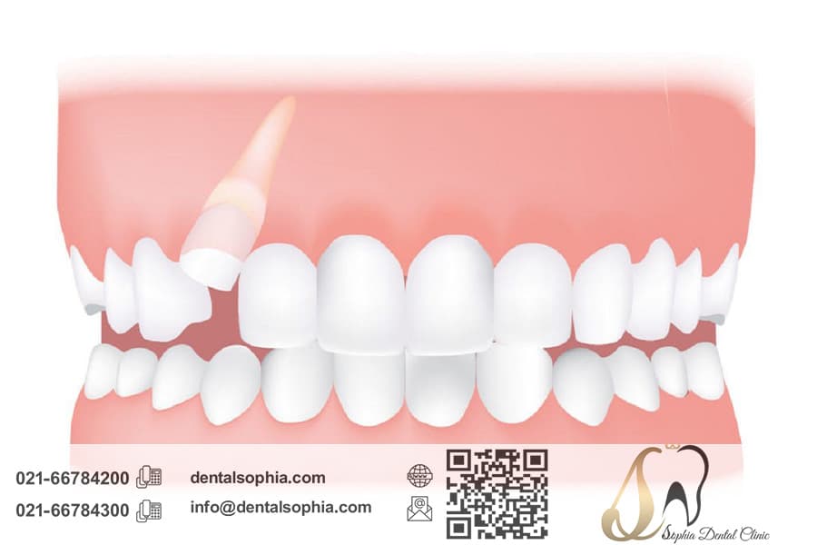 چالش‌ها و تکنیک‌های جراحی برای دندان‌های نهفته