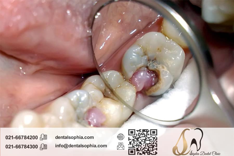 تاثیر عصب‌کشی دندان بر سلامتی عمومی بدن