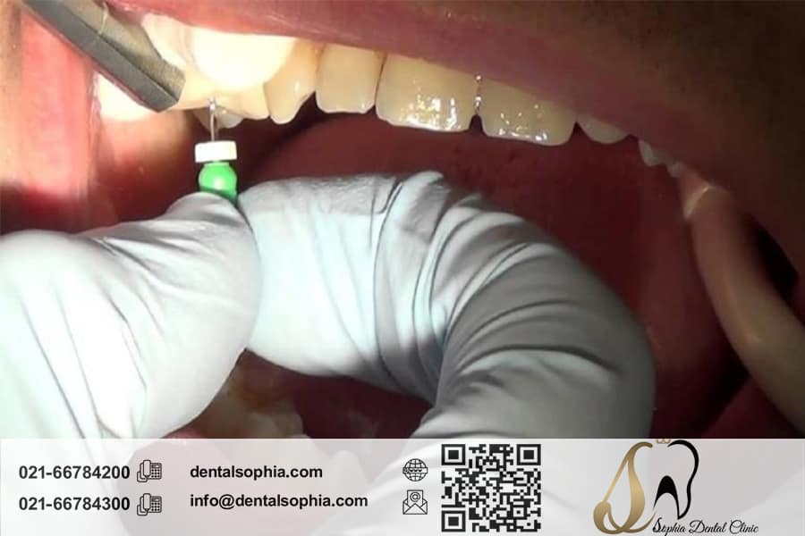 تاثیر عصب‌کشی دندان بر سلامتی عمومی بدن