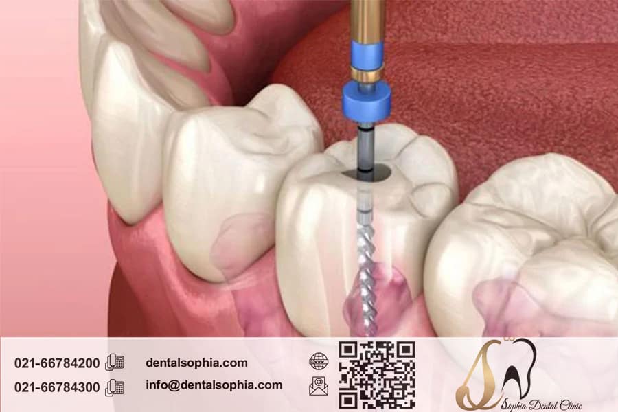 تاثیر عصب‌کشی دندان بر سلامتی عمومی بدن