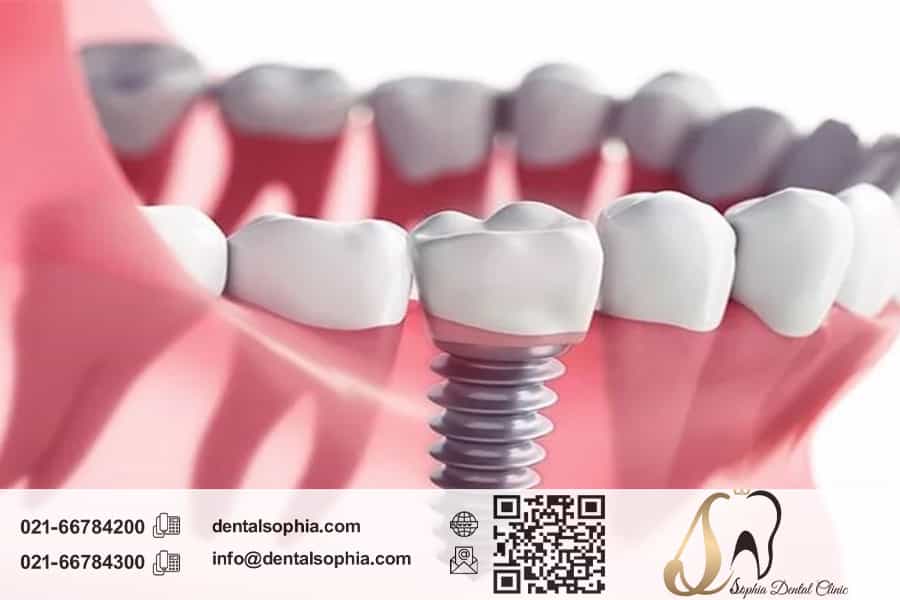 مزایای ایمپلنت دندان