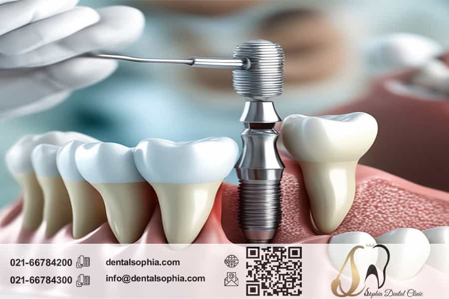 مزایای ایمپلنت دندان