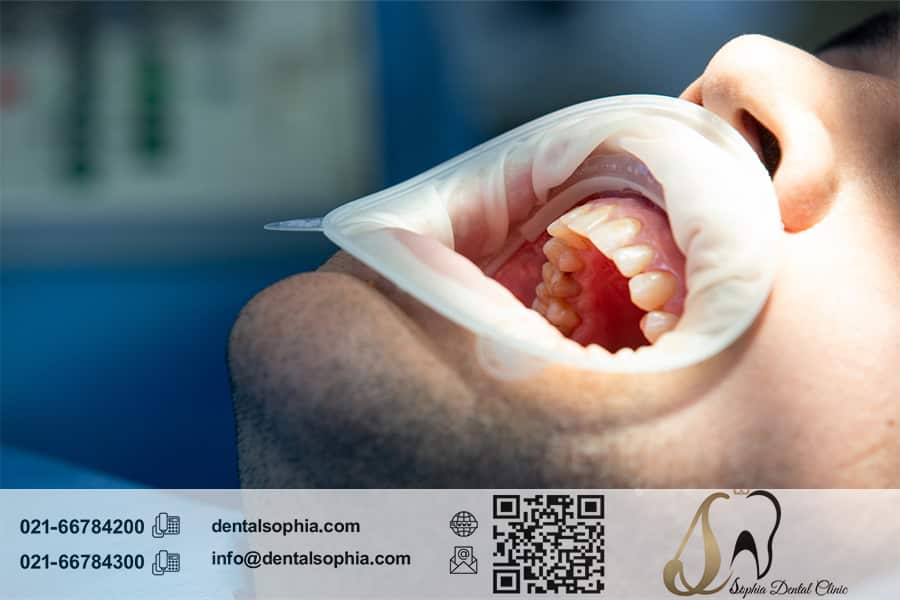 عوارض جراحی دندان و راه‌های پیشگیری از آن‌ها