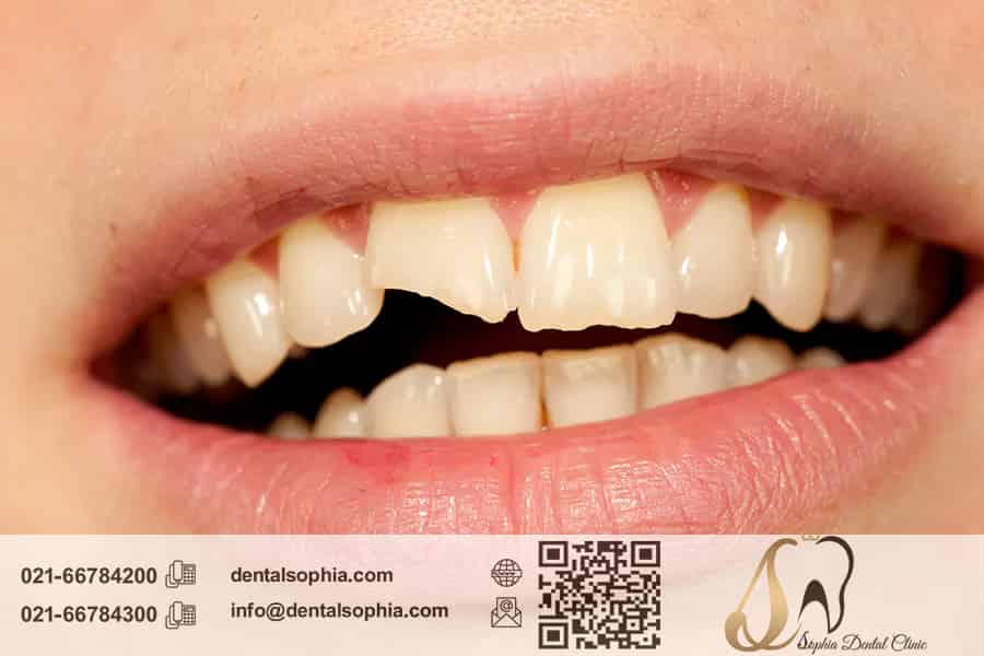 ترمیم دندان‌های شکسته یا ترک‌خورده