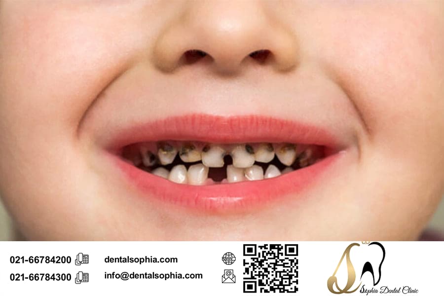 روش های پیشگیری از پوسیدگی دندان در کودکان