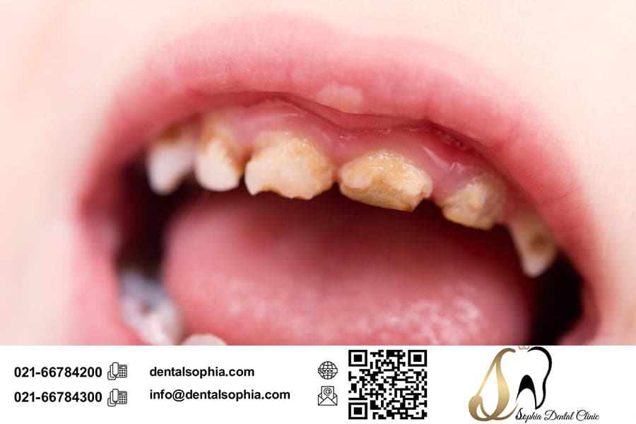 توضیحات کامل در رابطه با پوسیدگی دندان در کودکان