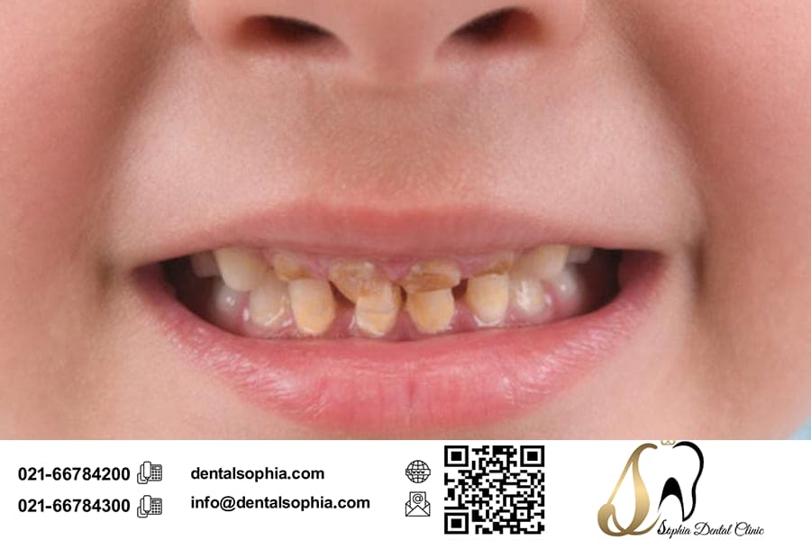 روش های پیشگیری از پوسیدگی دندان