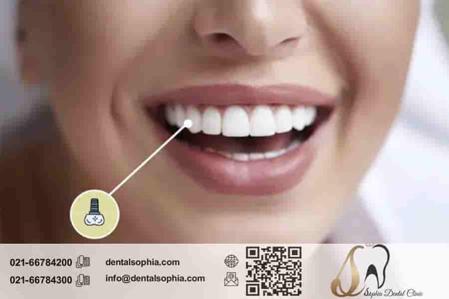 نگهداری از ایمپلنت دندان