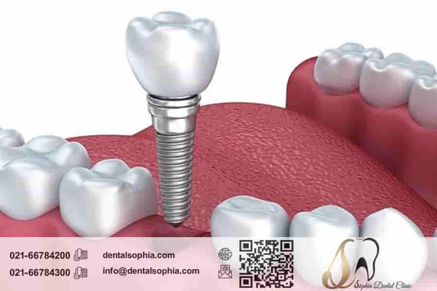 نگهداری از ایمپلنت دندان