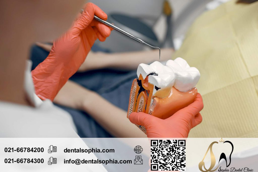 تصویر شاخص دلایل و علائم نیاز به درمان ریشه دندان