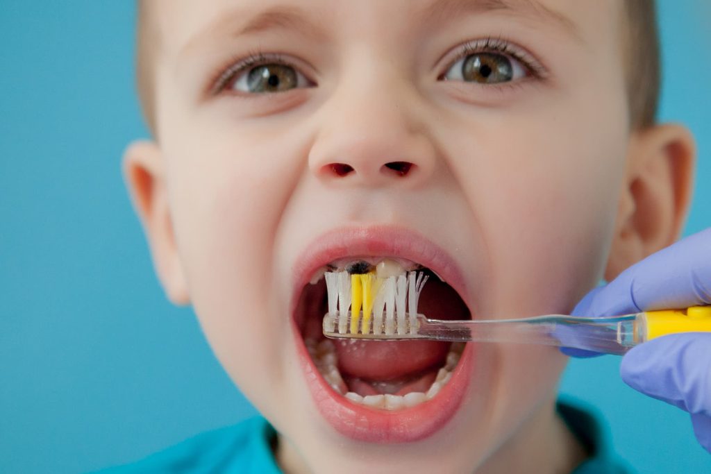 عکس شاخص روش‌های نوین تشخیص زودهنگام پوسیدگی دندان در کودکان پیش‌دبستانی