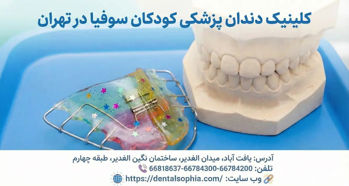 نمونه پلاک متحرک ارتودنسی رنگی و اکلیلی مخصوص کودکان در کنار قالب گچی دندان، مربوط به کلینیک دندانپزشکی تخصصی کودکان سوفیا در تهران