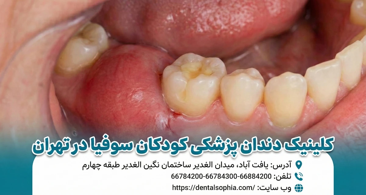 تصویری از تورم شدید و آبسه لثه در دهان یک کودک، به همراه اطلاعات تماس و آدرس کلینیک دندانپزشکی کودکان سوفیا در تهران برای درمان فوری." (این متن هم محتوای بصری را توصیف می‌کند و هم کلمات کلیدی مرتبط با درمان اورژانسی و محل کلینیک را در خود دارد.)